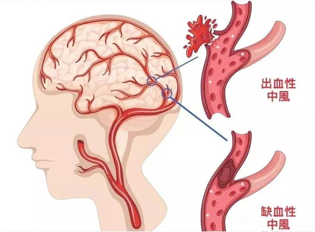 百万减残工程，防治卒中居民需提升识别能力，脑心健及时筛查预警